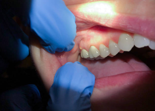 Best Emergency Dental Care for Abscessed Tooth in Brookfield, NJ